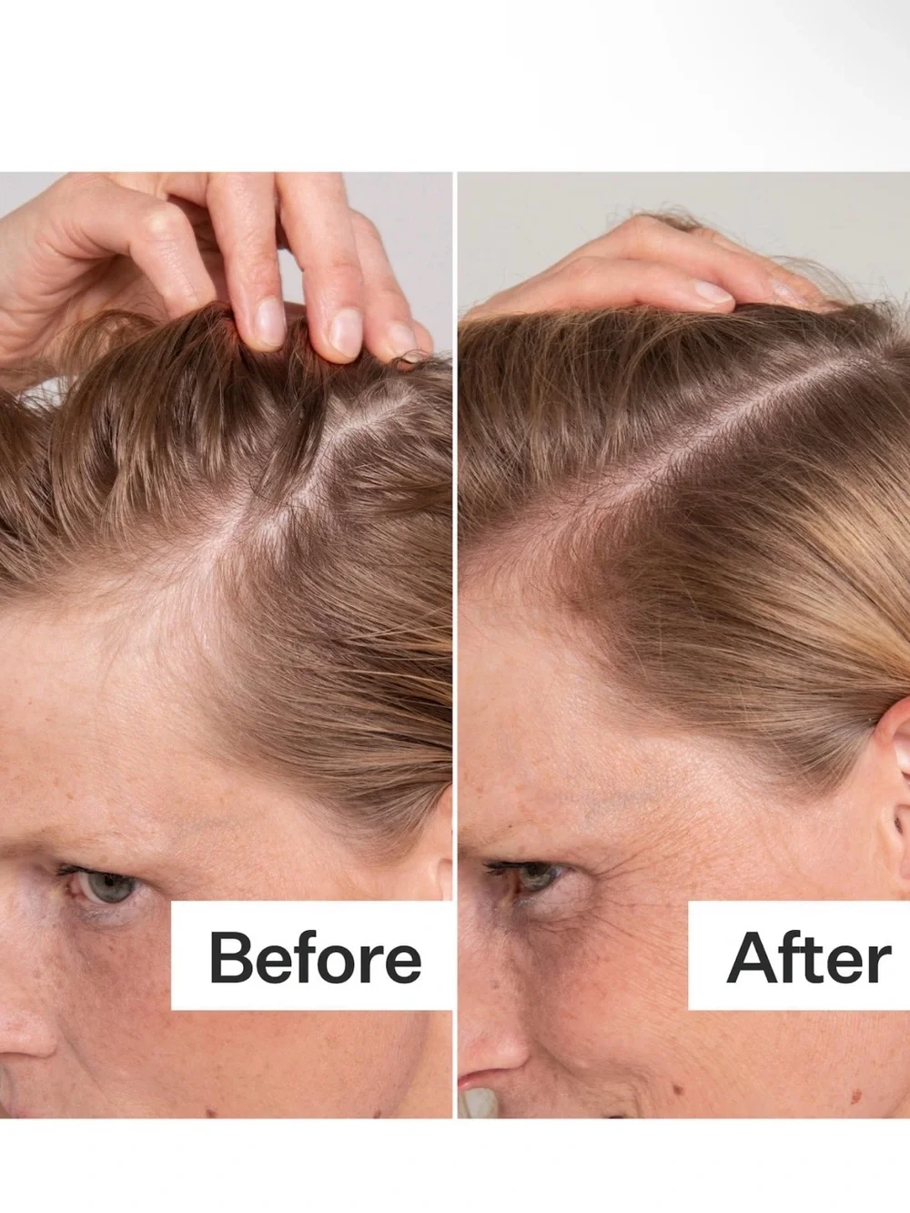 Act+Acre Salicylic Acid Scalp Exfoliator - with silver key